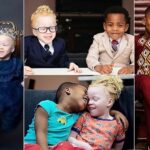 "They are twins" - Photos of albino girl and dark-skinned brother
