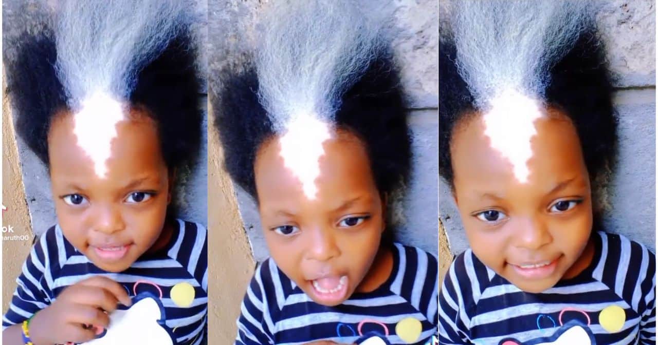 Little girl with shiny birthmark and white frontal hairs stirs reactions