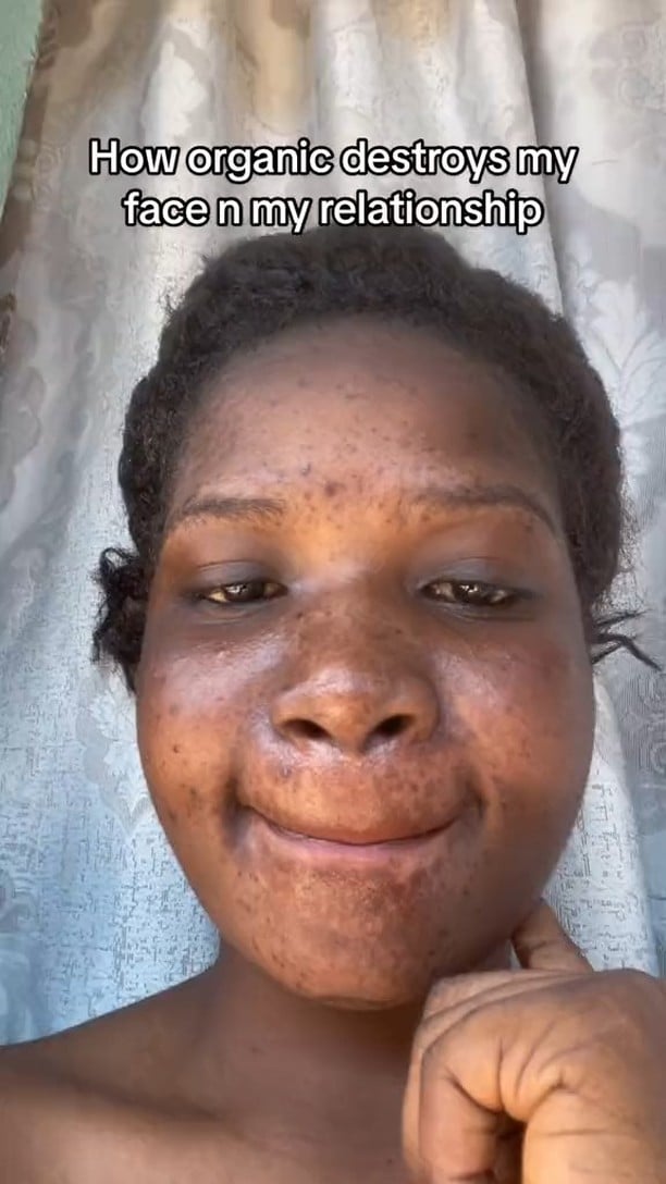 How organic cream ruined my face, broke my relationship — Heartbroken lady shares story (Video)