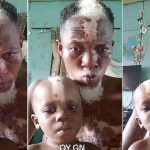 Father and son with white patches on their bodies stun many
