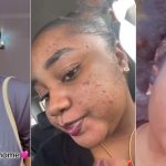 Nigerian lady laments over breakouts after relocating to Canada