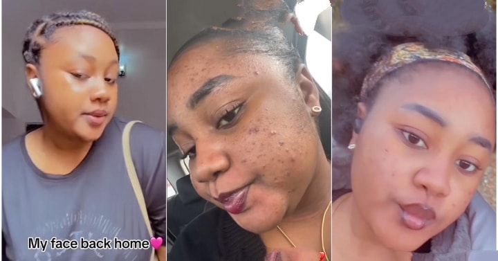 Nigerian lady laments over breakouts after relocating to Canada