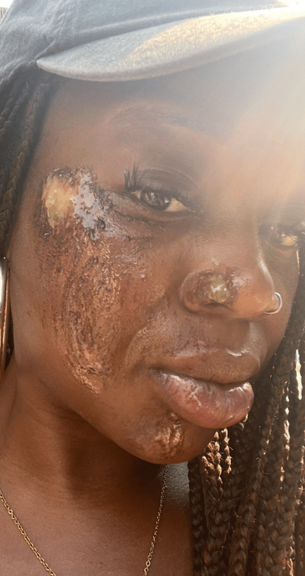 "This is unbelievable" - Nigerian lady stuns many as she shares photo of her face after surviving a fatal car accident